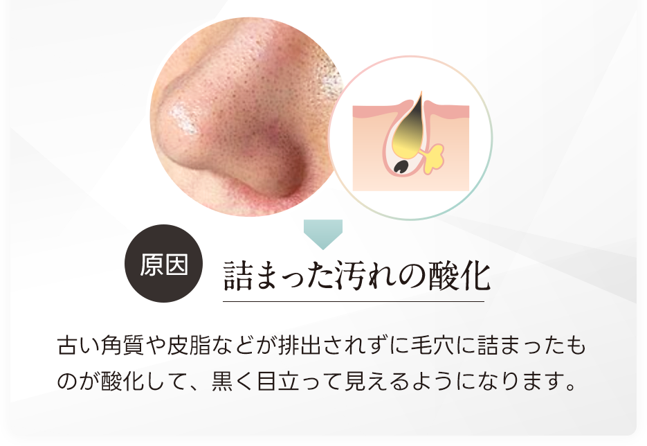 原因：詰まった汚れの酸化。古い角質や菱などが排出されずに毛穴に詰まったものが酸化して、黒く目立って見えるようになります。