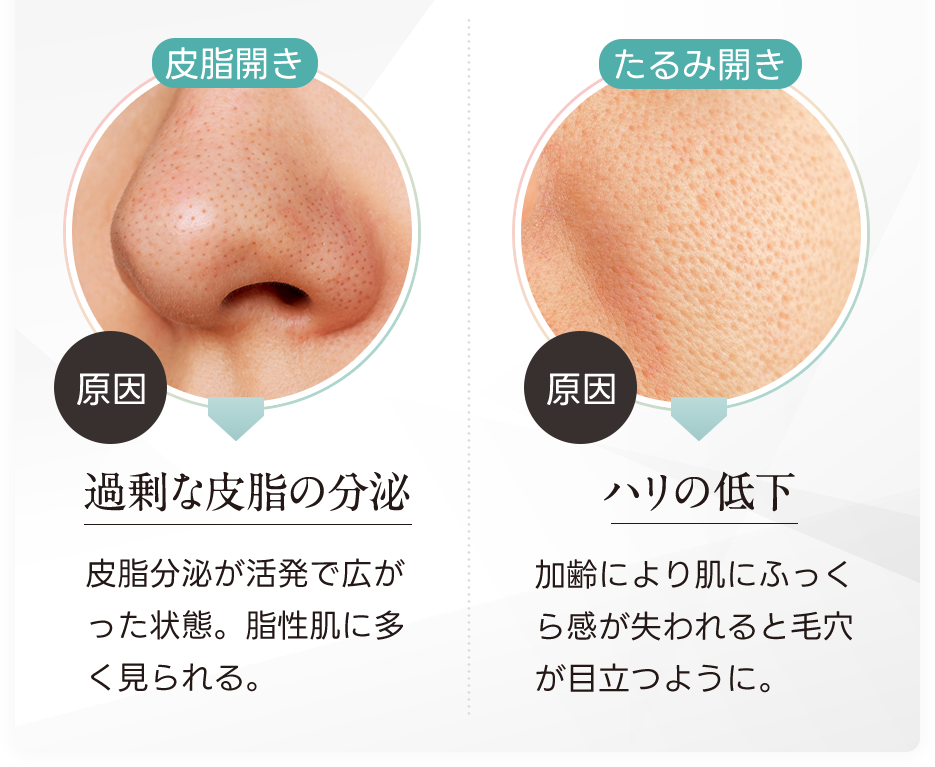 皮脂開きの原因は過剰な皮脂の分泌。皮脂分泌が活発で広がった状態。油性肌に多く見られる。たるみ開きの原因はハリの低下。彼によりふっくら感が失われると毛穴が目立つように。