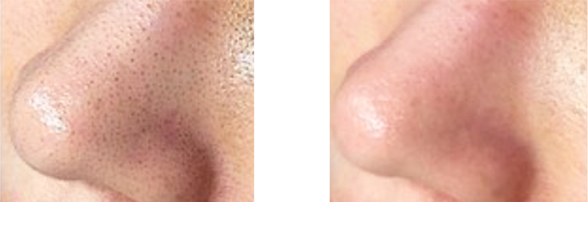 鼻の毛穴Before→After
