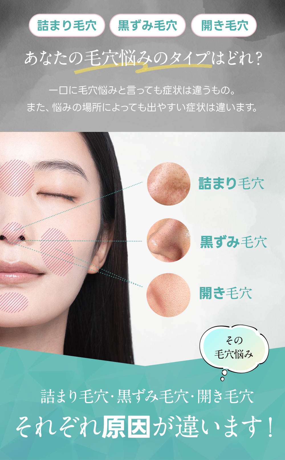 詰まり毛穴、黒ずみ毛穴、開き毛穴あなたの毛穴悩みタイプはどれ？一口に毛穴悩みといっても症状は違うもの。また、悩みの場所によっても出やすい症状は違います。