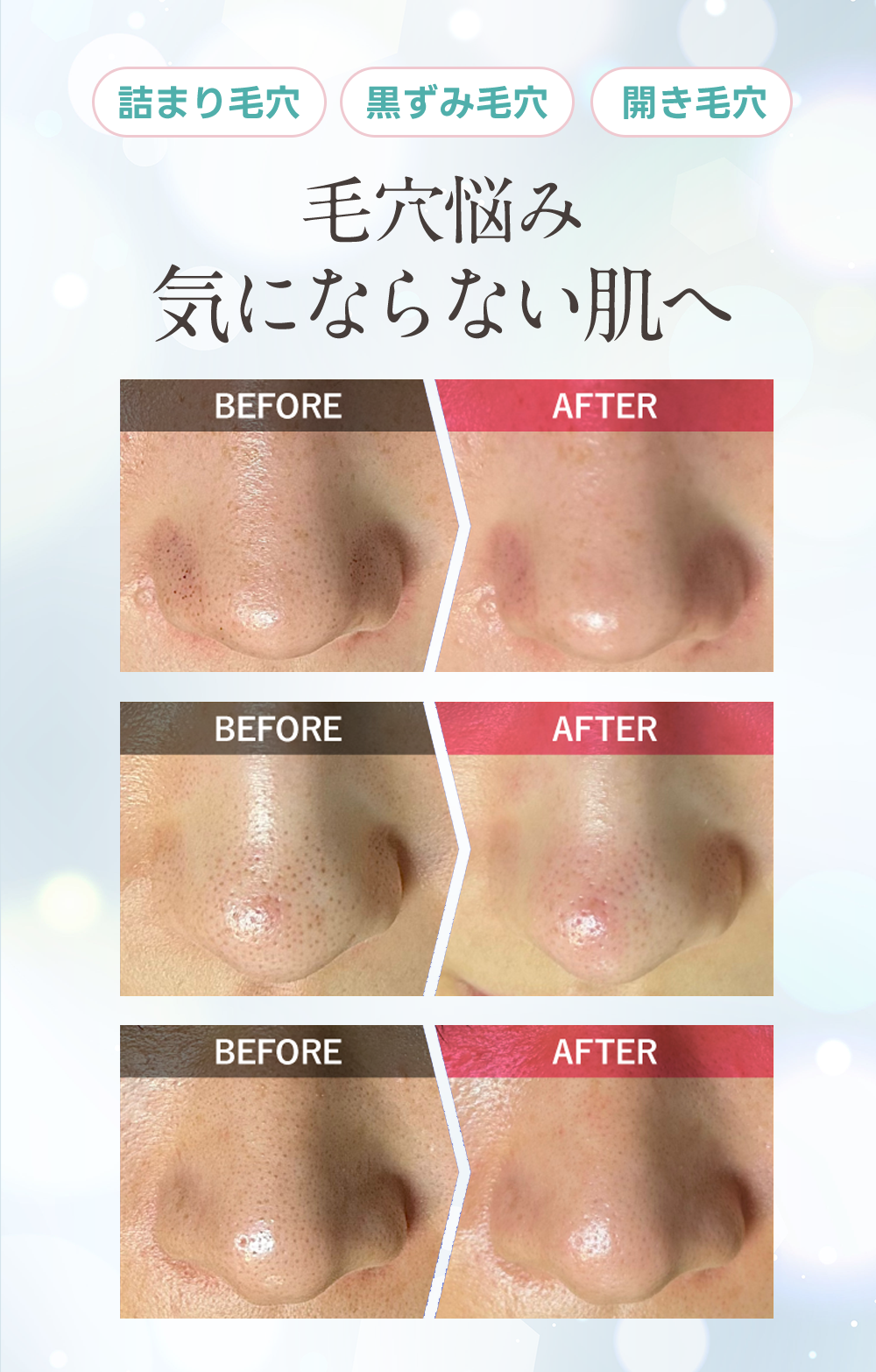 詰まり毛穴、黒ずみ毛穴、開き毛穴、毛穴悩み気にならない肌へ